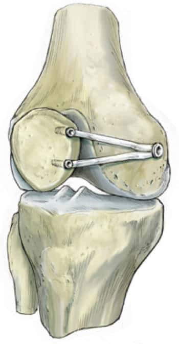 stabilization kneecap